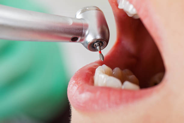 Best Emergency Wisdom Tooth Extraction in Clermont, FL